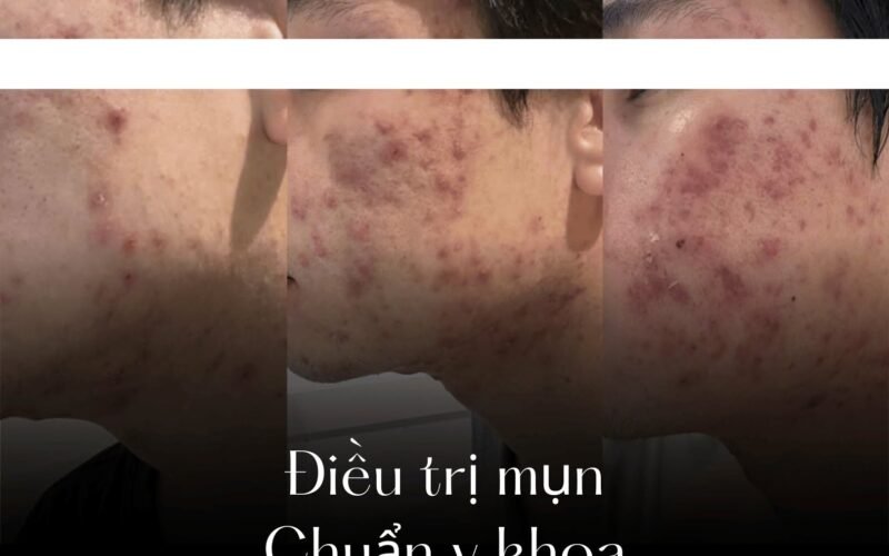 Trị mụn chuẩn y khoa