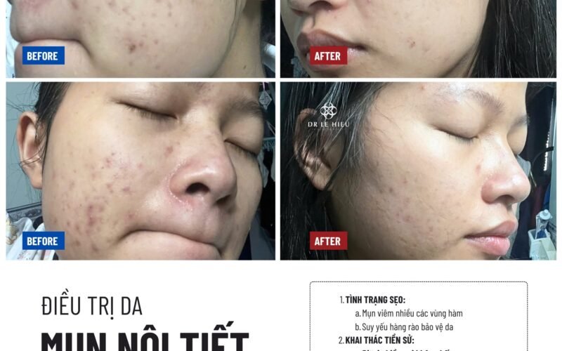 Điều trị mụn nội tiết
