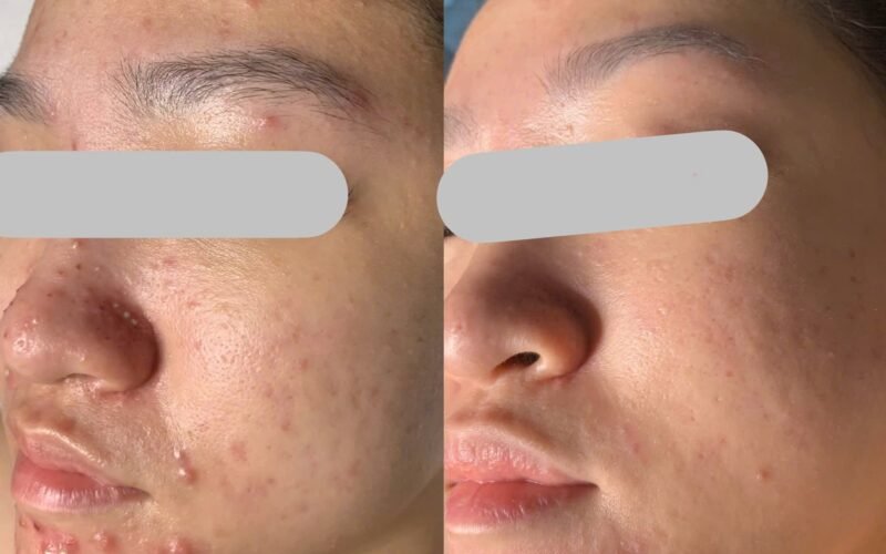 Điều trị mụn viêm