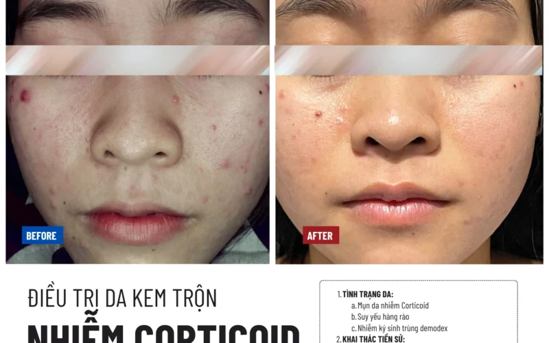 Phục hồi da nhiễm corticoid