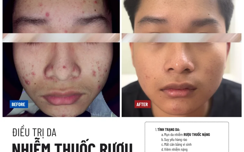 Phục hồi da nhiễm thuốc rượu