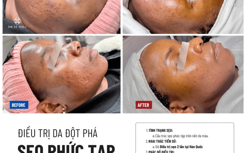 Điều trị sẹo phức tạp