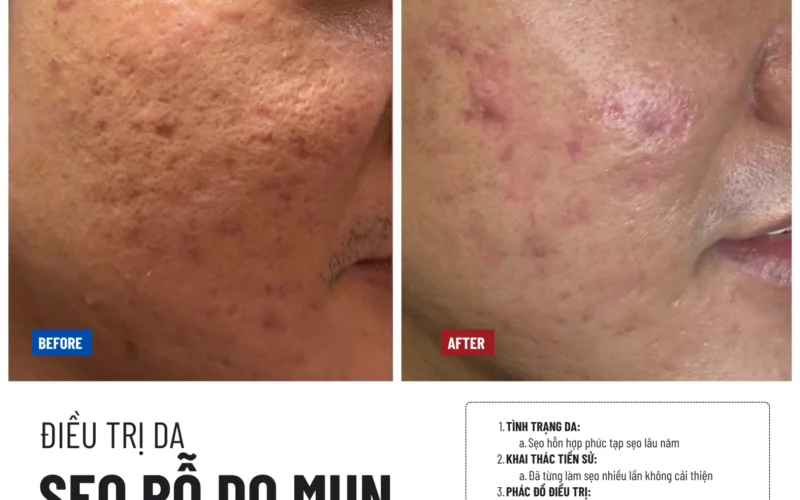 Điều trị sẹo rỗ do mụn