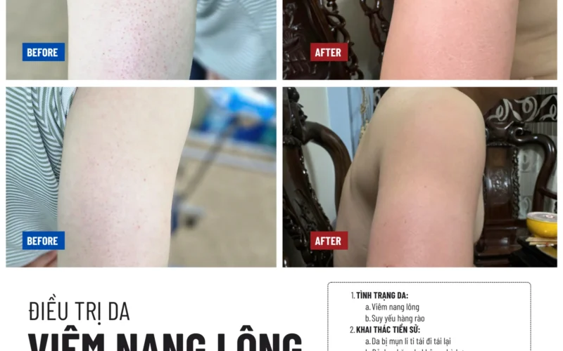 Điều trị viêm nang lông